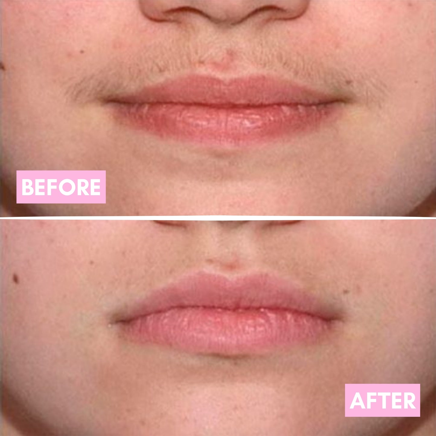 Cyperus Rotundus Hair Reduction Oil