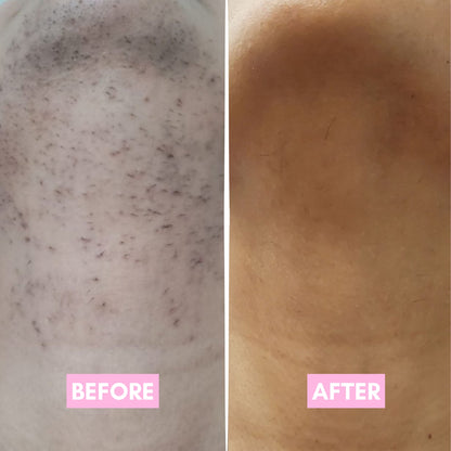 Cyperus Rotundus Hair Reduction Oil