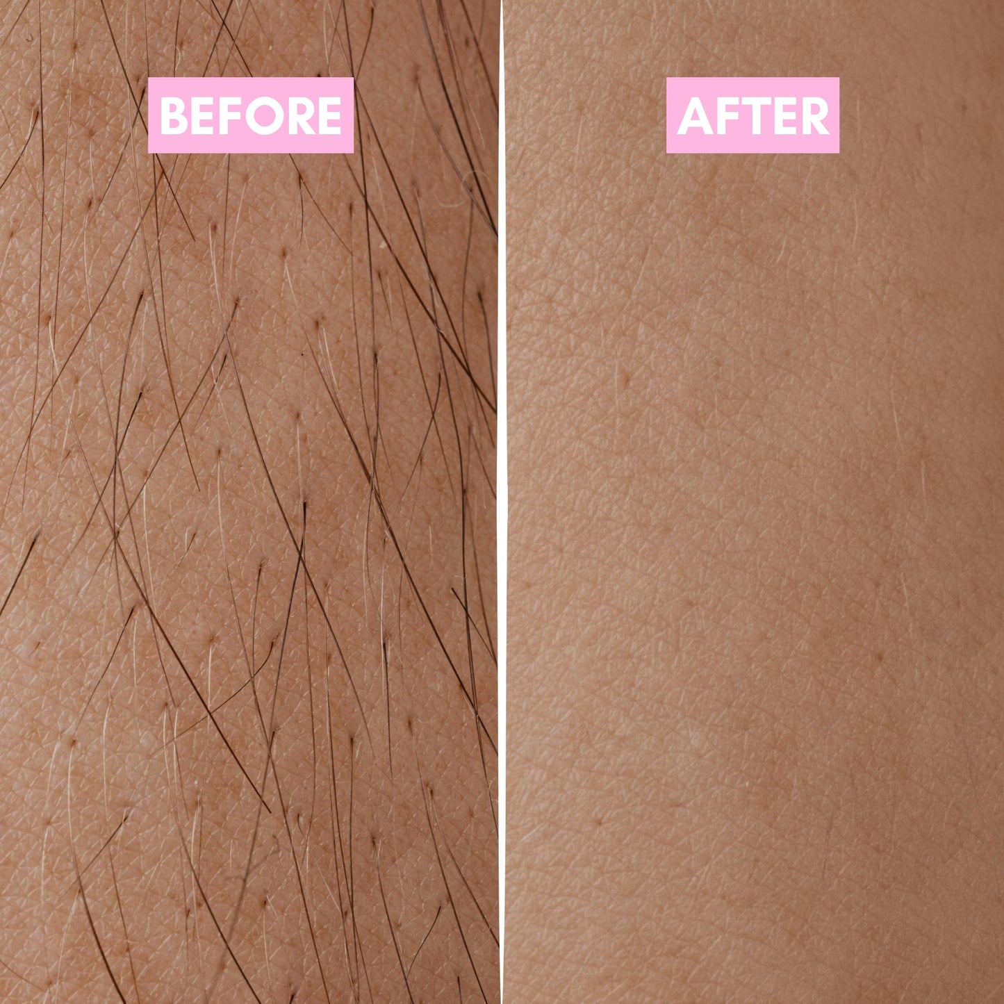 Cyperus Rotundus Hair Reduction Oil